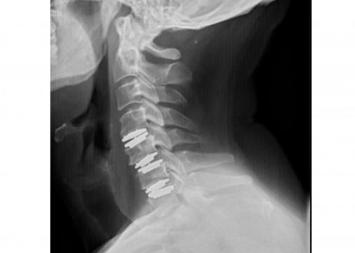 protesis-cervical-movil-instituto-cac
