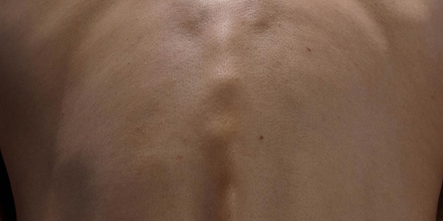 Qué es el síndrome de la cola de caballo