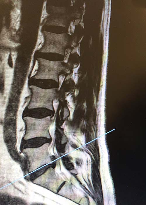 radiografia-hermia-discal-L5S1