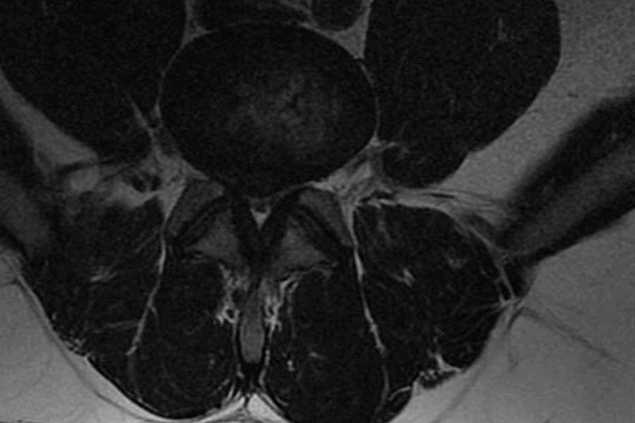 Resonancia con hernia discal L4l5 corte axial
