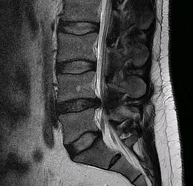 Resonancia con hernia discal