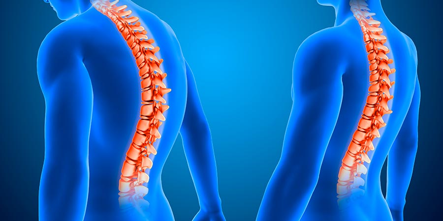 Síntomas de un tumor vertebral