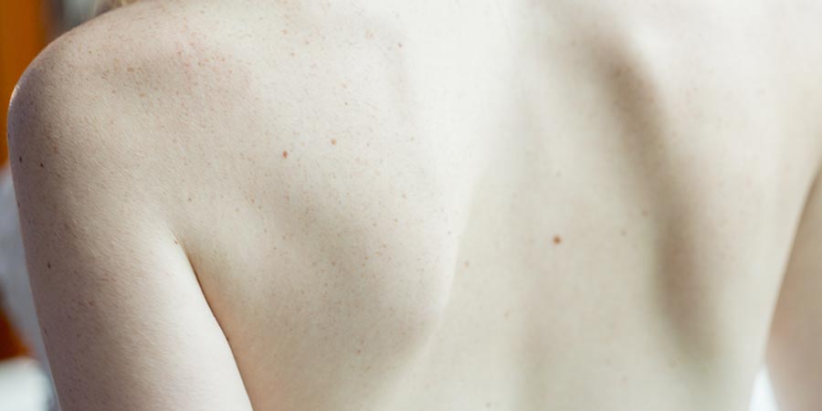 Tratamiento para Síndrome de la cola de caballo