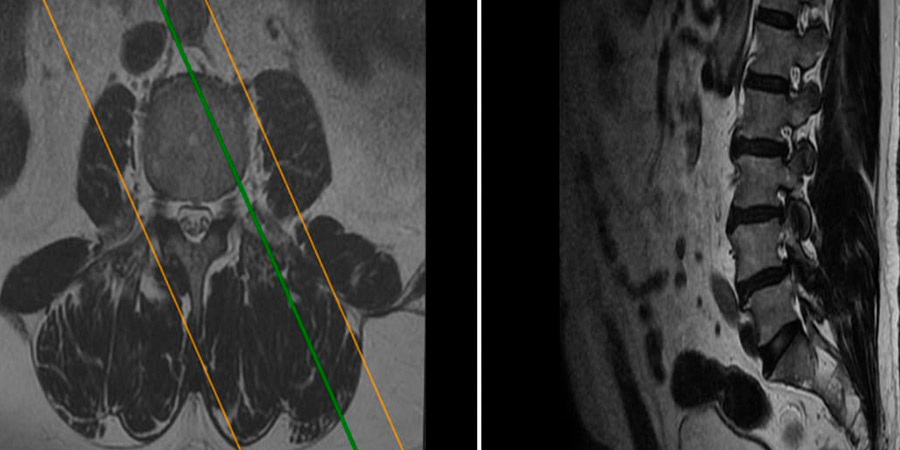 tumores-intradurales-en-la-espina-dorsal
