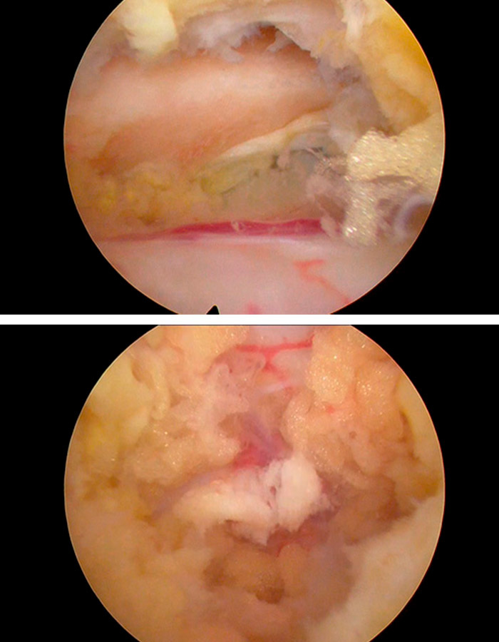 Vision endoscopia del canal cervical