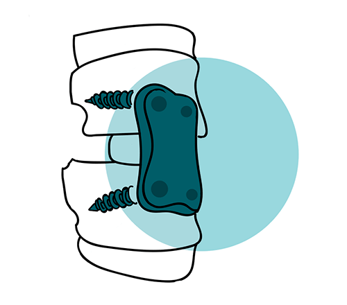 icono artrodesis lumbar tratamiento columna