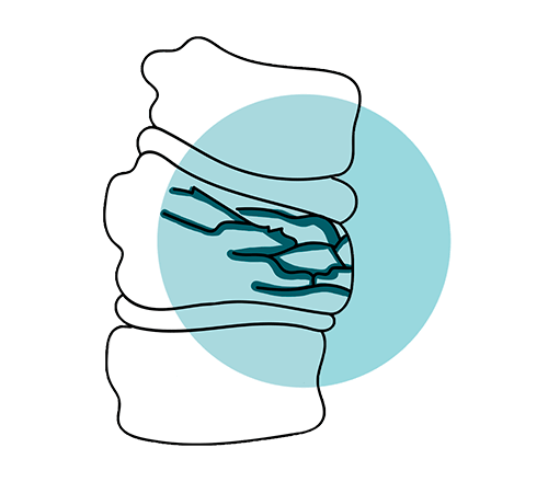 icono fractura de vertebras de la columna