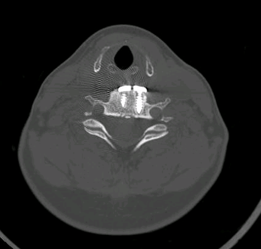 Imagen TAC columna vertebral