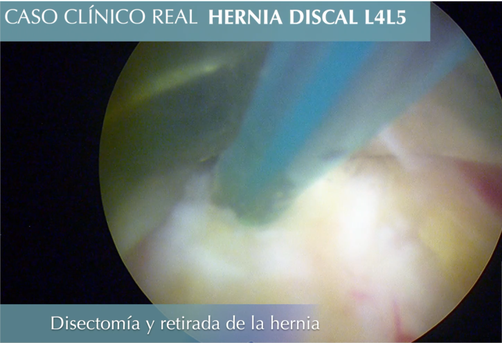 Retirada de una hernia lumbar mediante endoscopia avanzada de columna